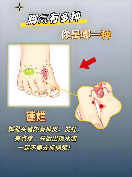 脚臭怎么根治_脚痒是脚气吗